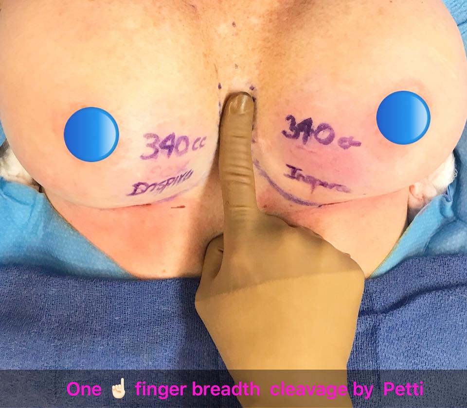Breast Augmentation with One Fingerbreadth Cleavage  Christine Petti, M.D,  F.A.C.S. Board Certified Plastic Surgeon